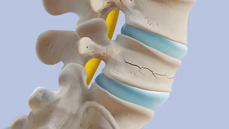 Immagine di una colonna vertebrale lombare